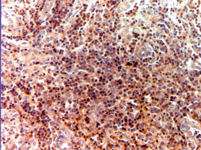 Fig.9: TCRBCL. CD3 - <div style=